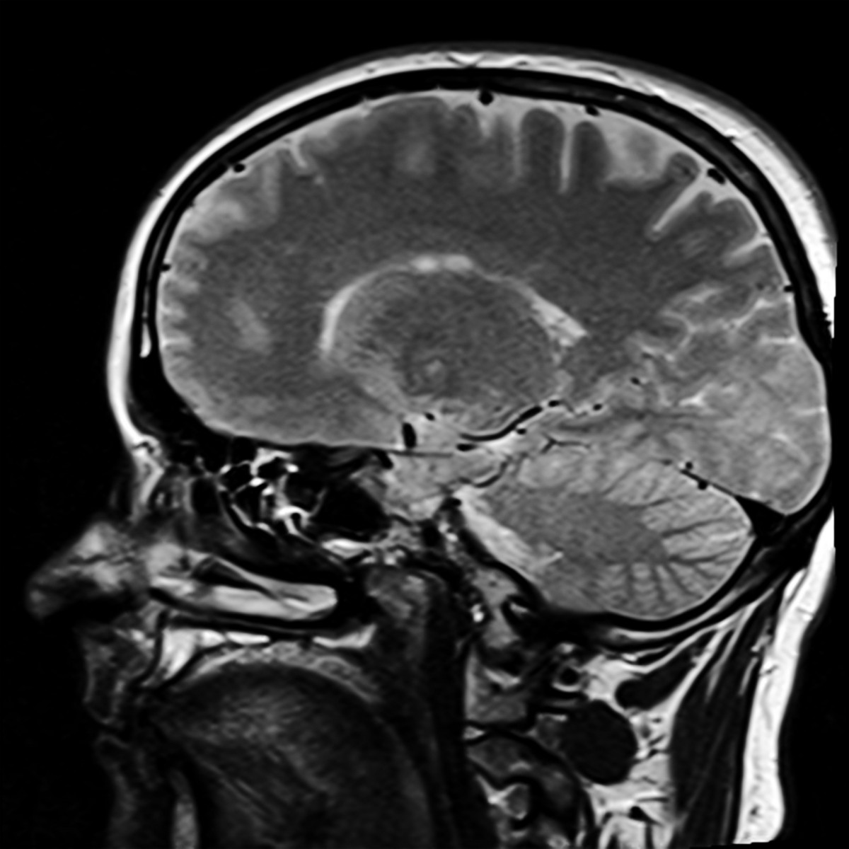 Magnetic resonance image of a brain